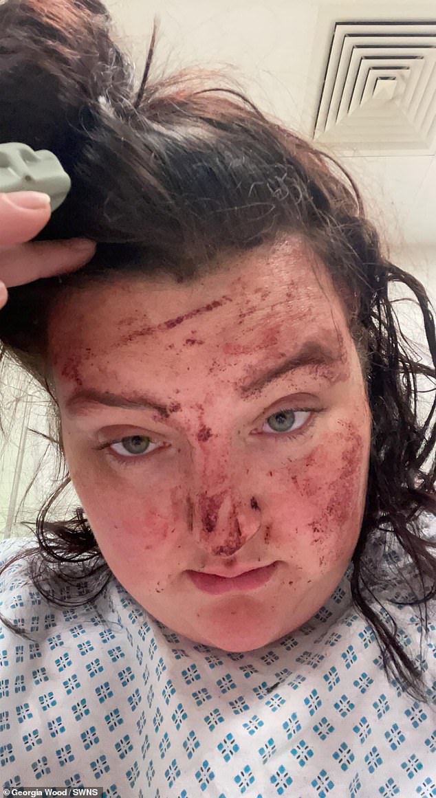 Georgia Wood, 22, pictured in hospital, suffered a miscarriage, bleed on the brain and gashes and cuts to her head, knees and ankles after the car hit her in Scunthorpe
