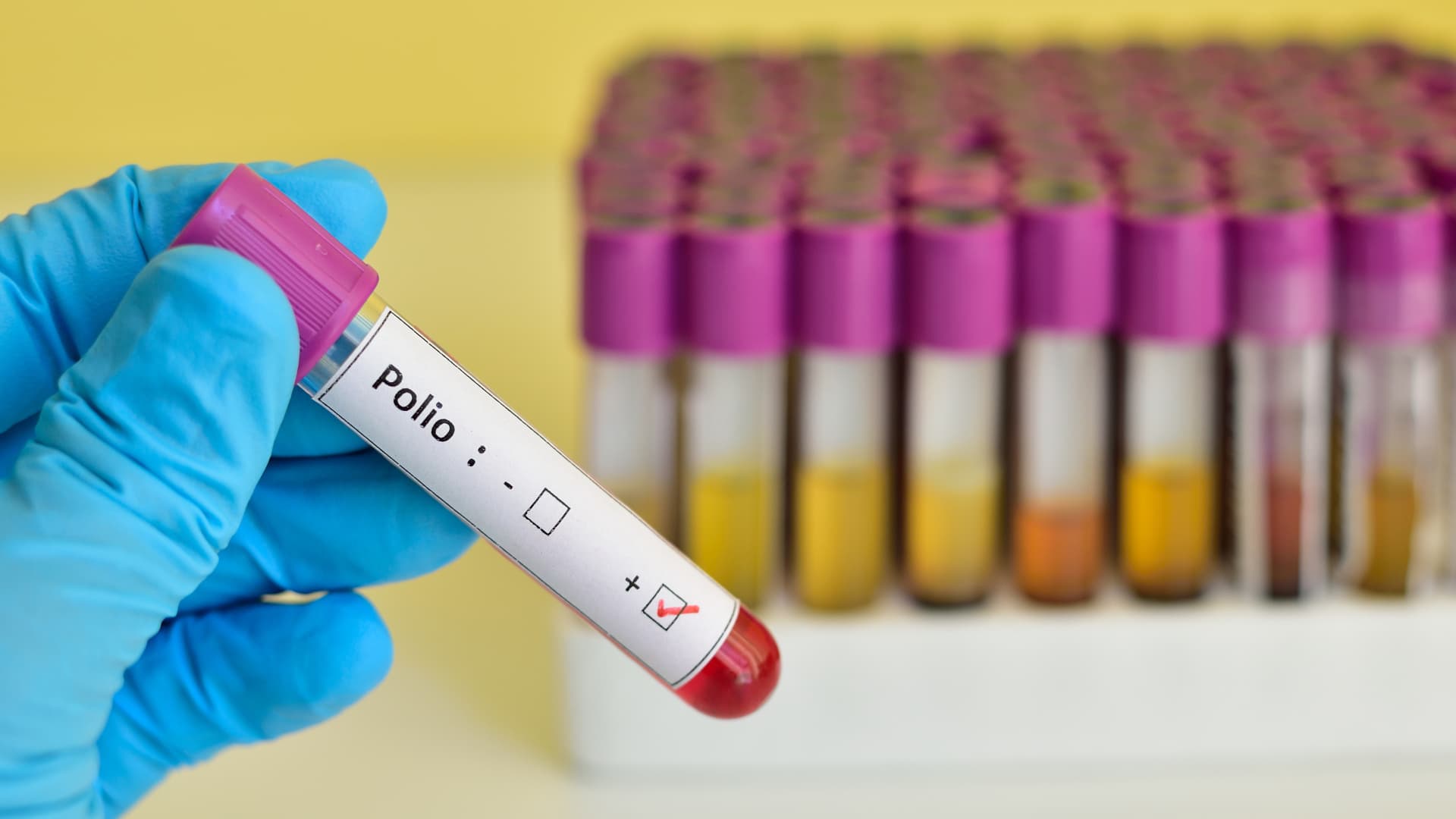 Blood sample positive with polio virus