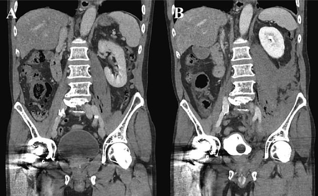 CT scans of the man revealed the development of fluid and and gas on the left side of his boy near the pelvis, indicated on the scan by the 'fuzzy' nature of the image. Upon committing to surgery medics would need to remove 50 per cent of one of the group of muscles connecting his back and pelvis, with the tissue having become necrotic